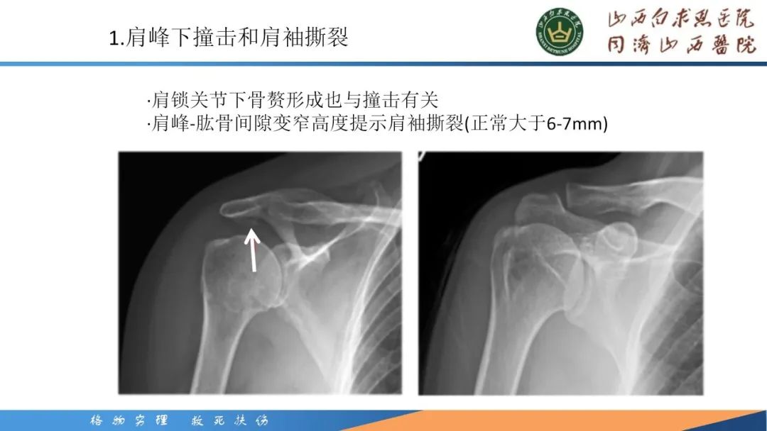 影像PPT - 【PPT】肩关节损伤的MRI表现-13