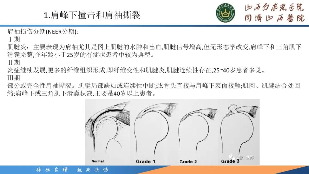 影像PPT - 【PPT】肩关节损伤的MRI表现-15