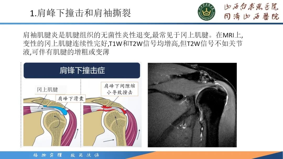 影像PPT - 【PPT】肩关节损伤的MRI表现-16