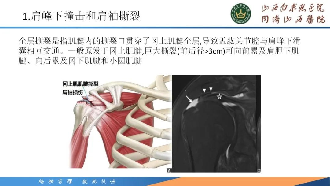 影像PPT - 【PPT】肩关节损伤的MRI表现-17