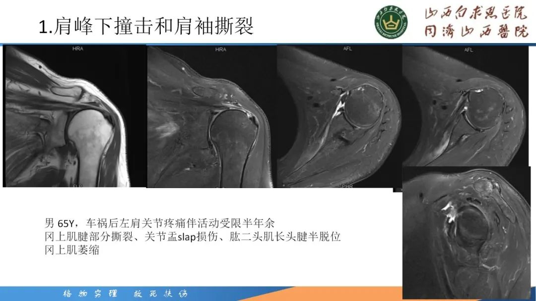 影像PPT - 【PPT】肩关节损伤的MRI表现-19
