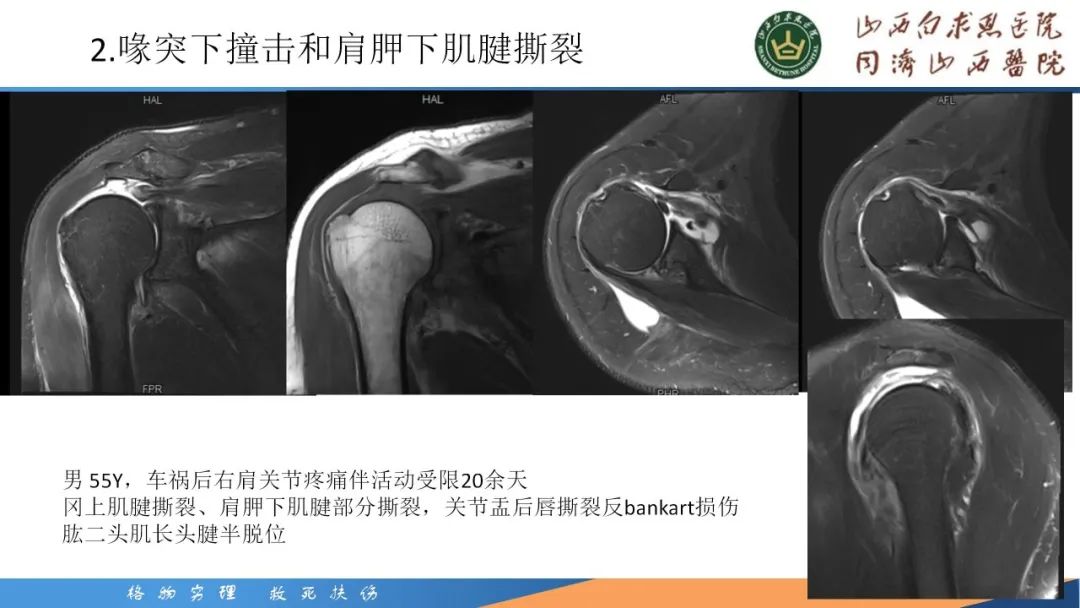 影像PPT - 【PPT】肩关节损伤的MRI表现-21