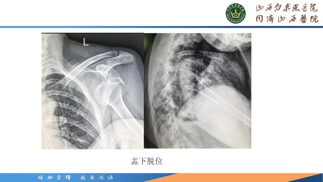 影像PPT - 【PPT】肩关节损伤的MRI表现-28