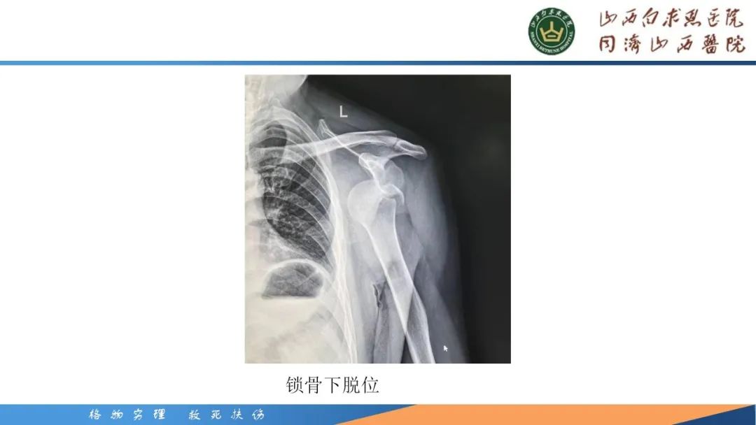 影像PPT - 【PPT】肩关节损伤的MRI表现-30