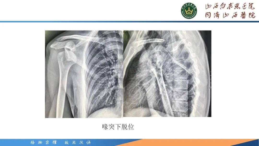 影像PPT - 【PPT】肩关节损伤的MRI表现-29