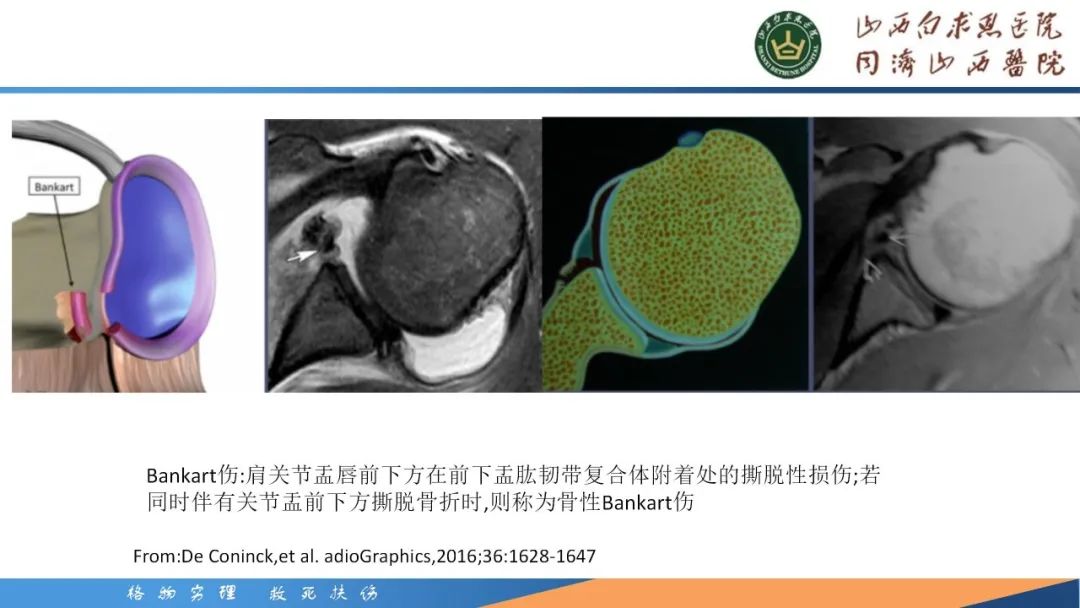 影像PPT - 【PPT】肩关节损伤的MRI表现-32
