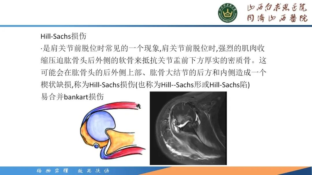 影像PPT - 【PPT】肩关节损伤的MRI表现-34
