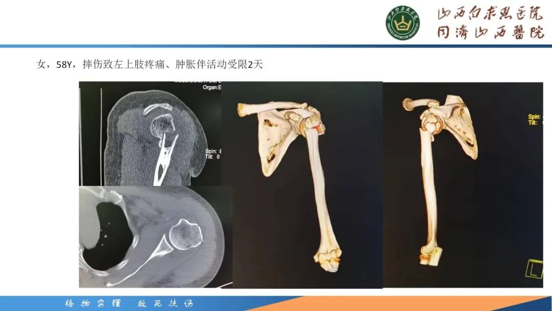 影像PPT - 【PPT】肩关节损伤的MRI表现-40