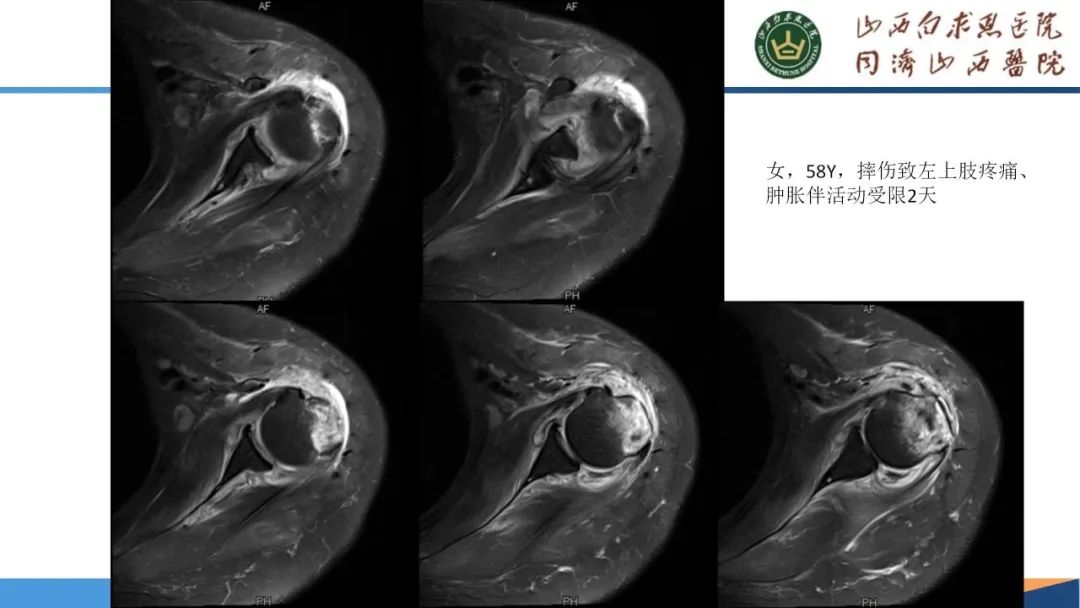影像PPT - 【PPT】肩关节损伤的MRI表现-42