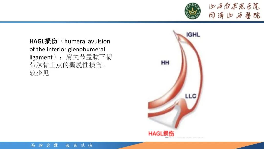 影像PPT - 【PPT】肩关节损伤的MRI表现-44