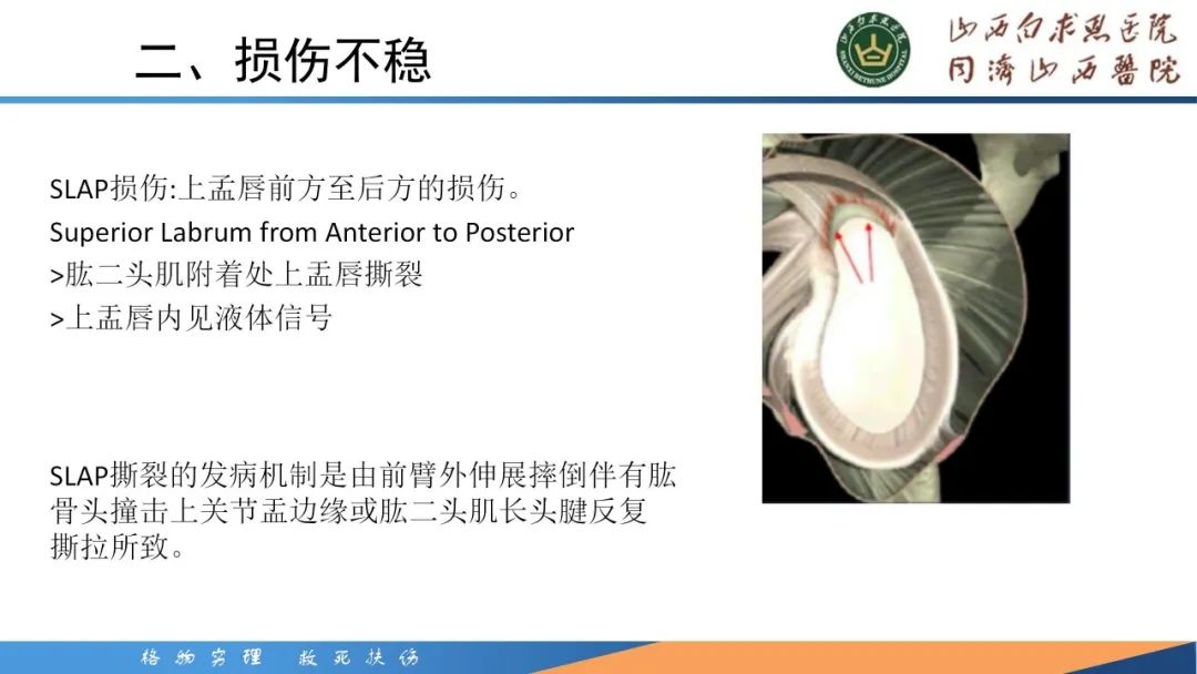影像PPT - 【PPT】肩关节损伤的MRI表现-47