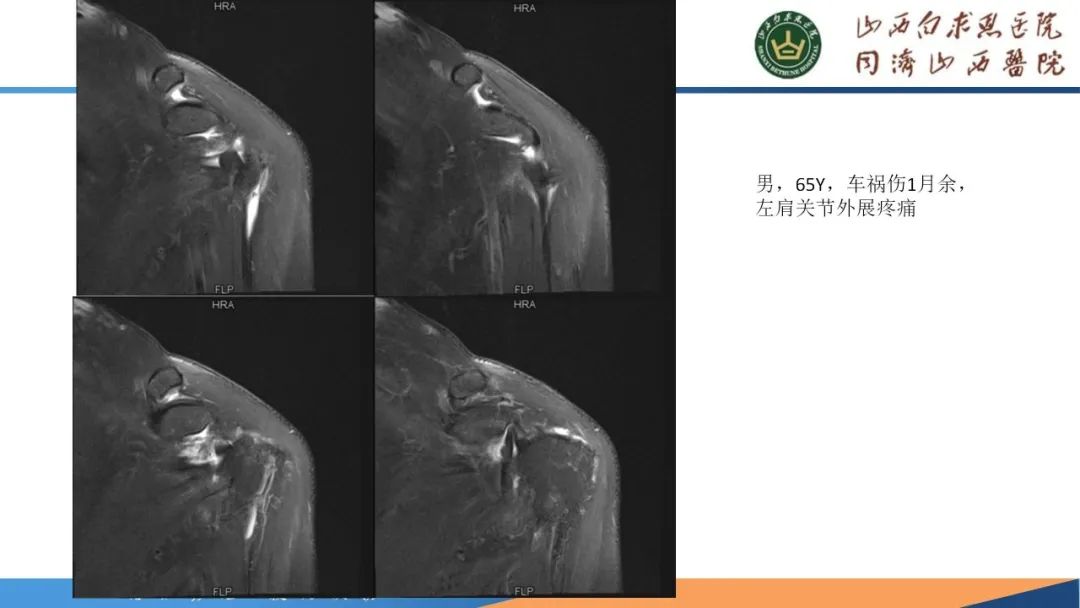影像PPT - 【PPT】肩关节损伤的MRI表现-48