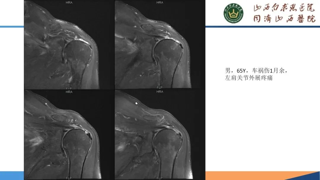 影像PPT - 【PPT】肩关节损伤的MRI表现-49