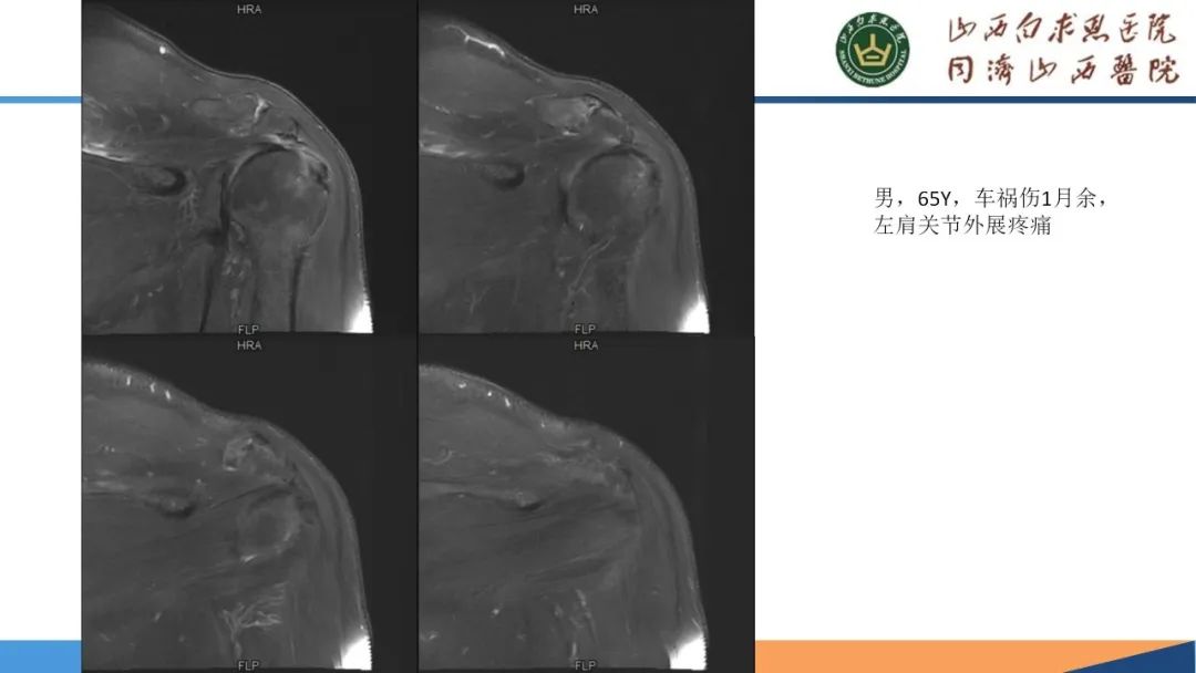 影像PPT - 【PPT】肩关节损伤的MRI表现-50