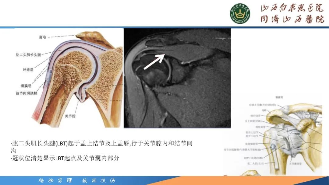 影像PPT - 【PPT】肩关节损伤的MRI表现-54