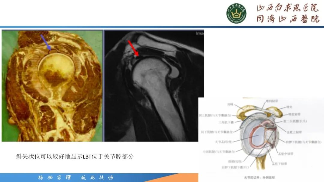 影像PPT - 【PPT】肩关节损伤的MRI表现-55