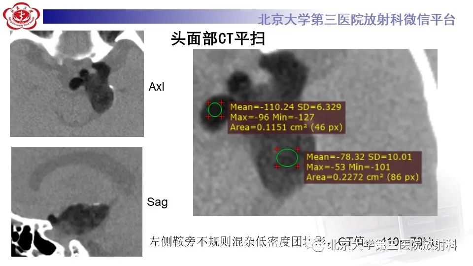 影像PPT - 【PPT】鞍旁表皮样囊肿/胆脂瘤-3
