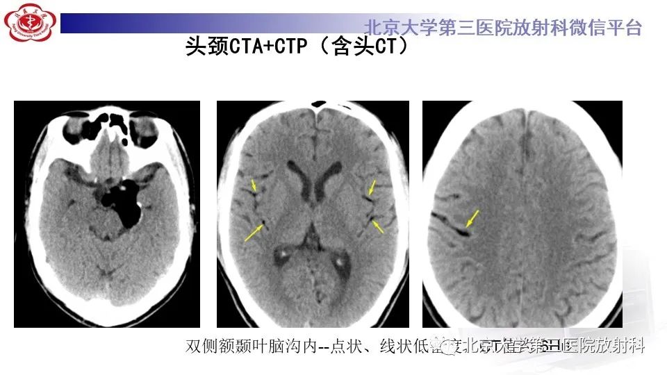 影像PPT - 【PPT】鞍旁表皮样囊肿/胆脂瘤-4