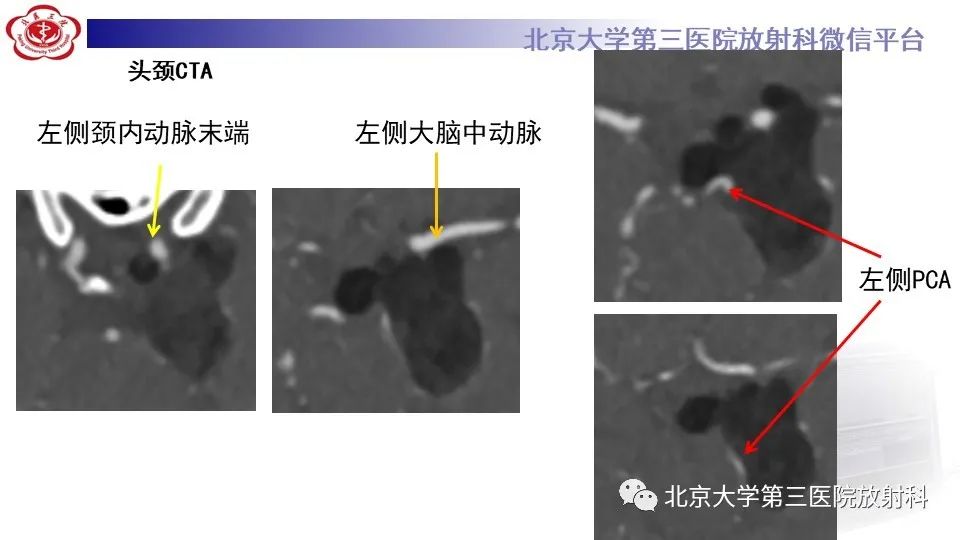 影像PPT - 【PPT】鞍旁表皮样囊肿/胆脂瘤-5