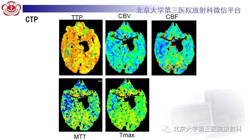影像PPT - 【PPT】鞍旁表皮样囊肿/胆脂瘤-6