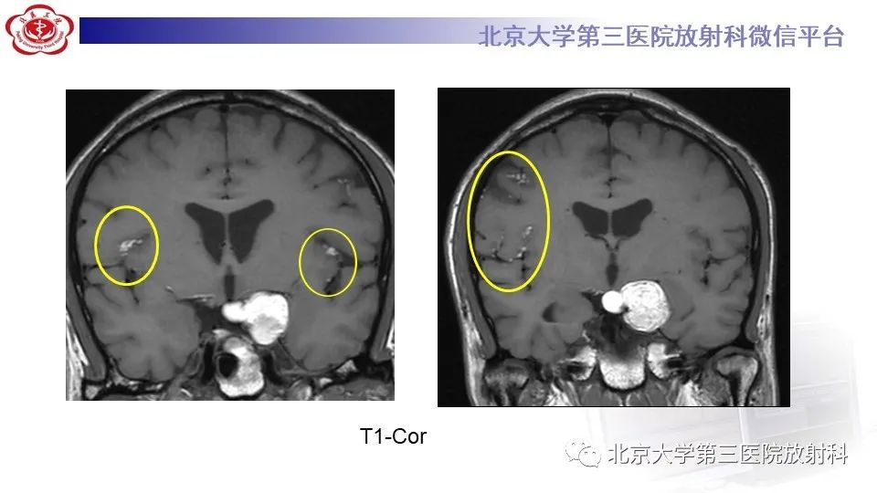 影像PPT - 【PPT】鞍旁表皮样囊肿/胆脂瘤-8