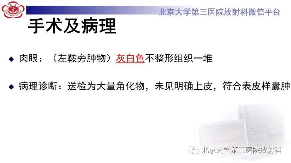 影像PPT - 【PPT】鞍旁表皮样囊肿/胆脂瘤-11