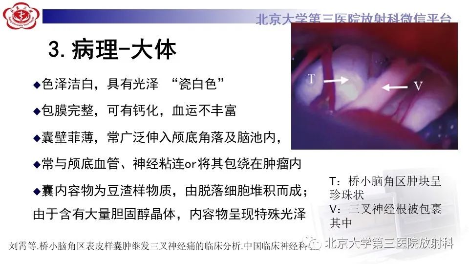 影像PPT - 【PPT】鞍旁表皮样囊肿/胆脂瘤-15