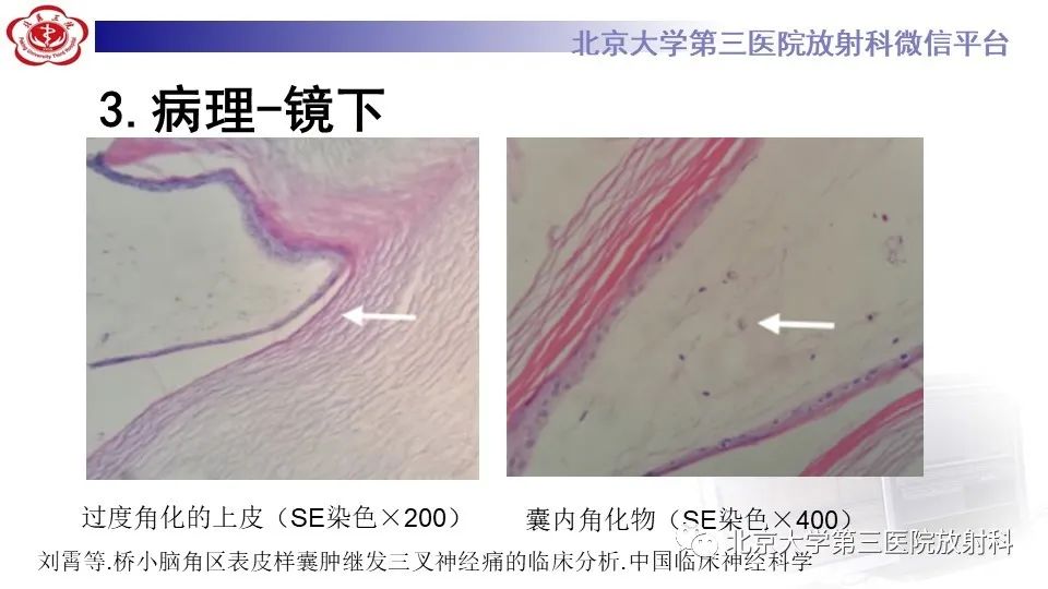 影像PPT - 【PPT】鞍旁表皮样囊肿/胆脂瘤-17