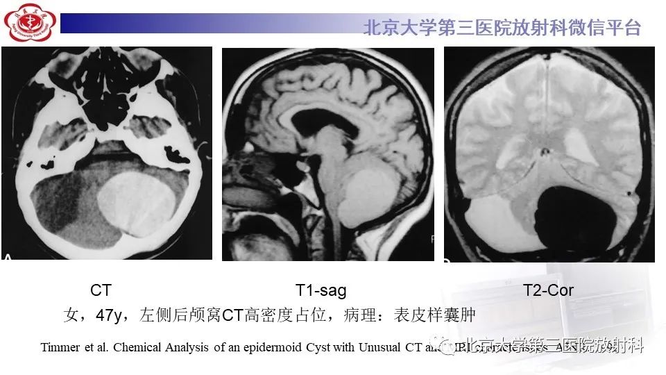 影像PPT - 【PPT】鞍旁表皮样囊肿/胆脂瘤-24