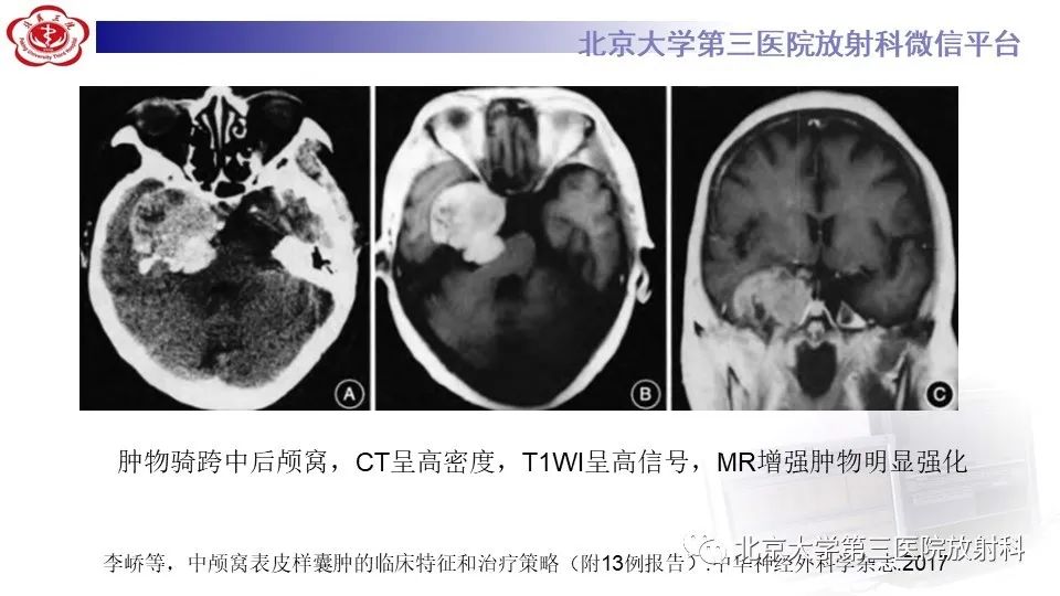 影像PPT - 【PPT】鞍旁表皮样囊肿/胆脂瘤-25