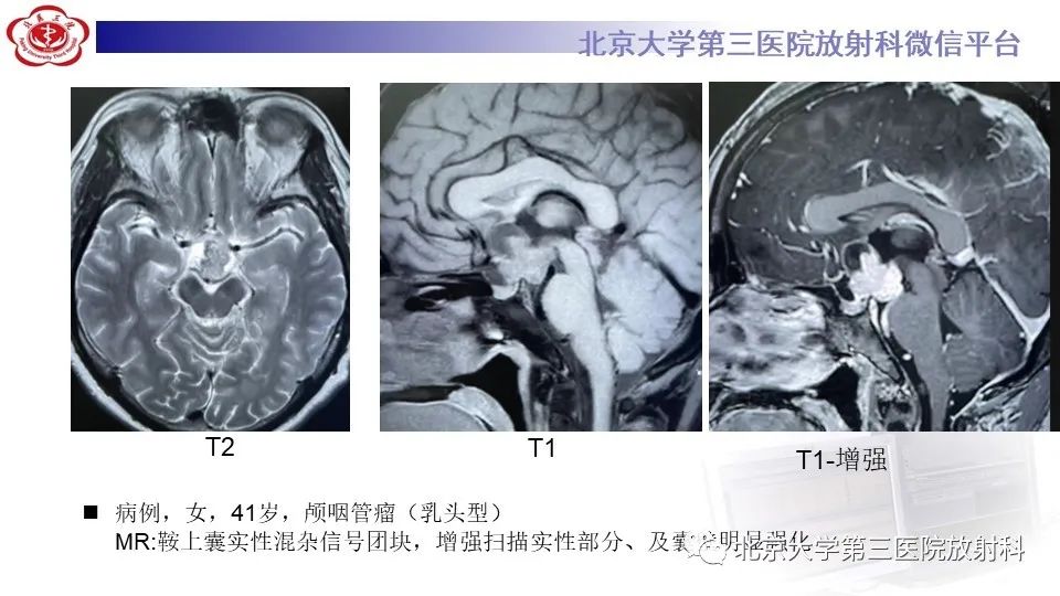 影像PPT - 【PPT】鞍旁表皮样囊肿/胆脂瘤-27