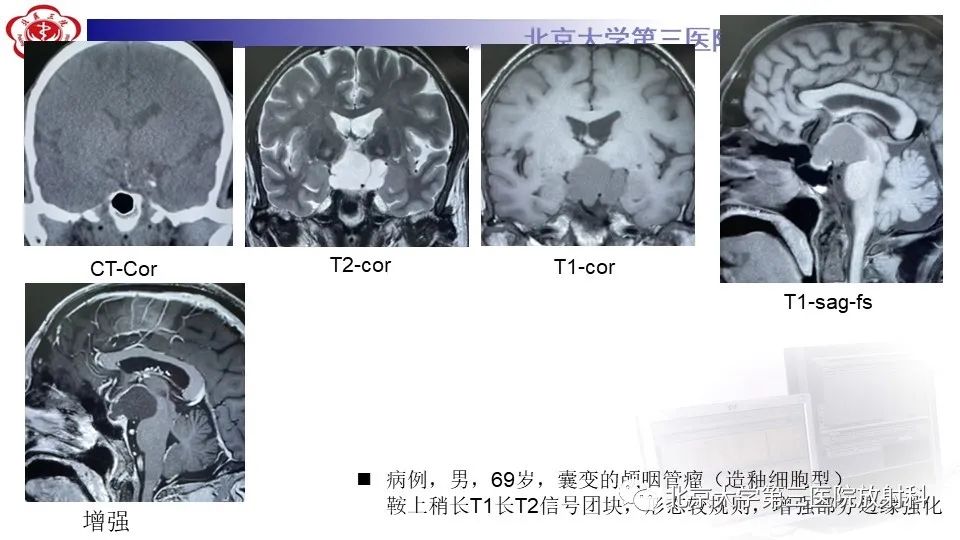 影像PPT - 【PPT】鞍旁表皮样囊肿/胆脂瘤-28