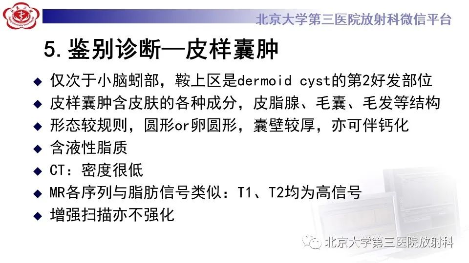影像PPT - 【PPT】鞍旁表皮样囊肿/胆脂瘤-29