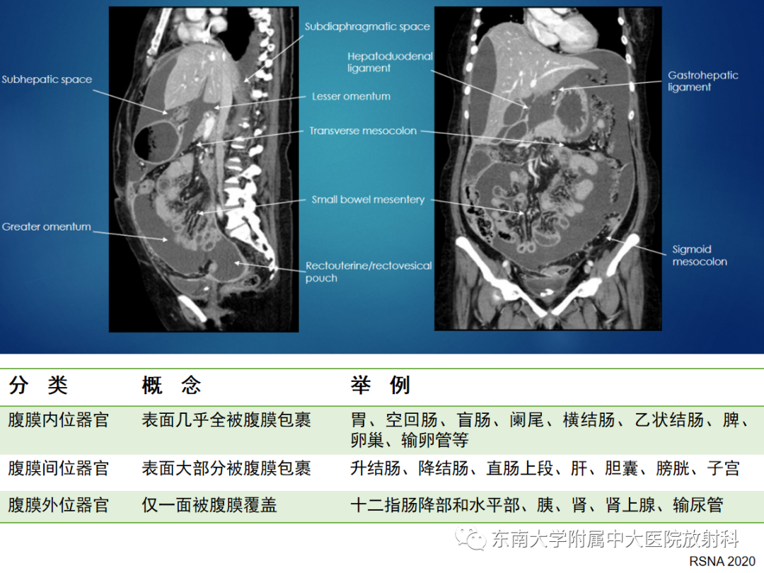 影像PPT - 【PPT】腹膜弥漫性病变-3
