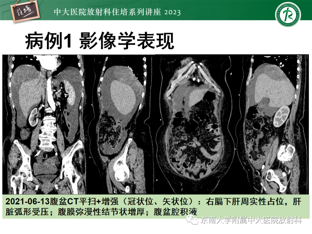 影像PPT - 【PPT】腹膜弥漫性病变-7