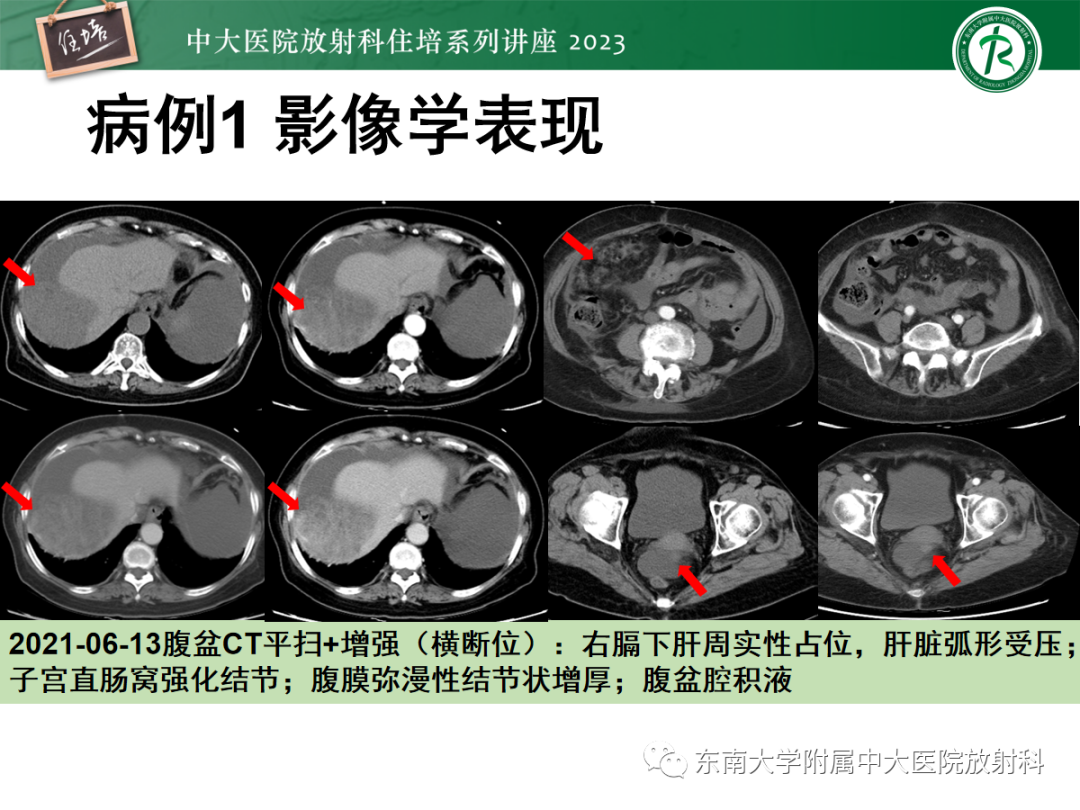 影像PPT - 【PPT】腹膜弥漫性病变-6
