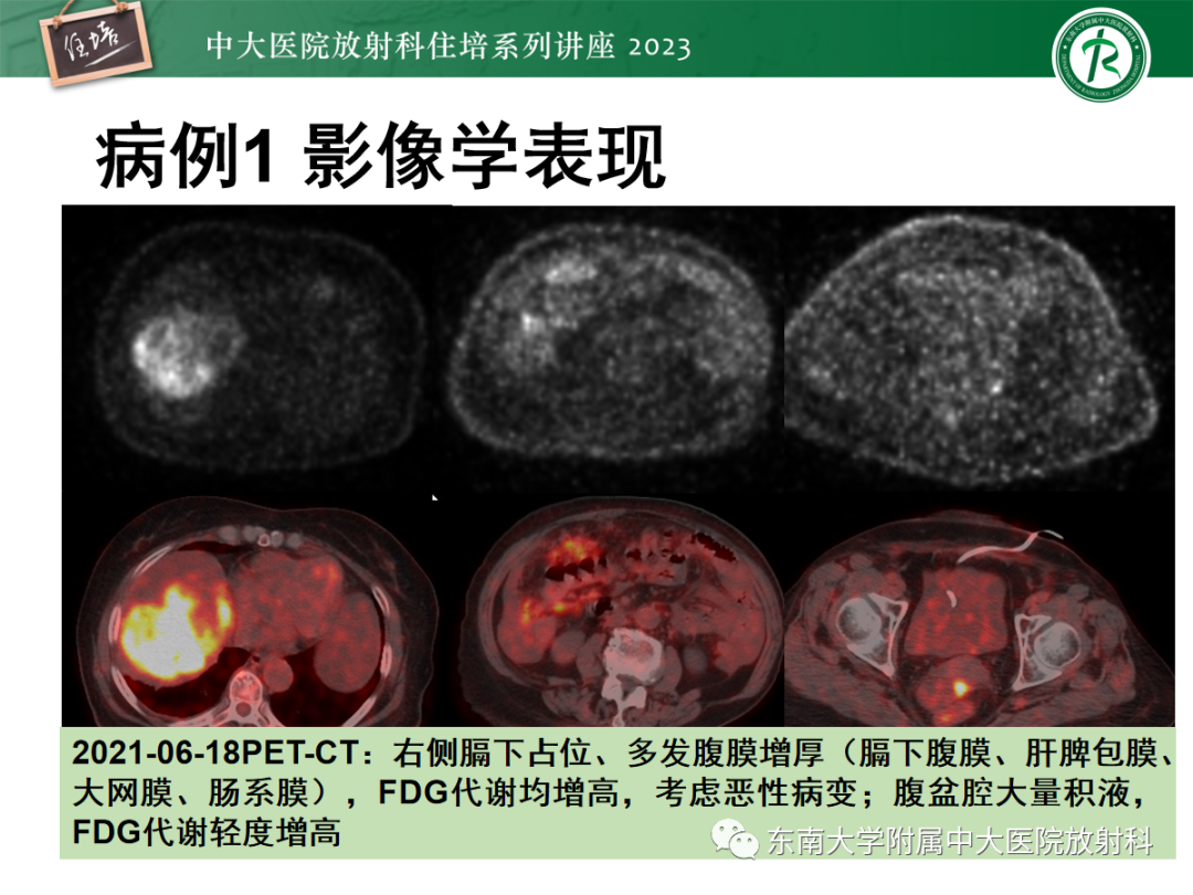 影像PPT - 【PPT】腹膜弥漫性病变-8