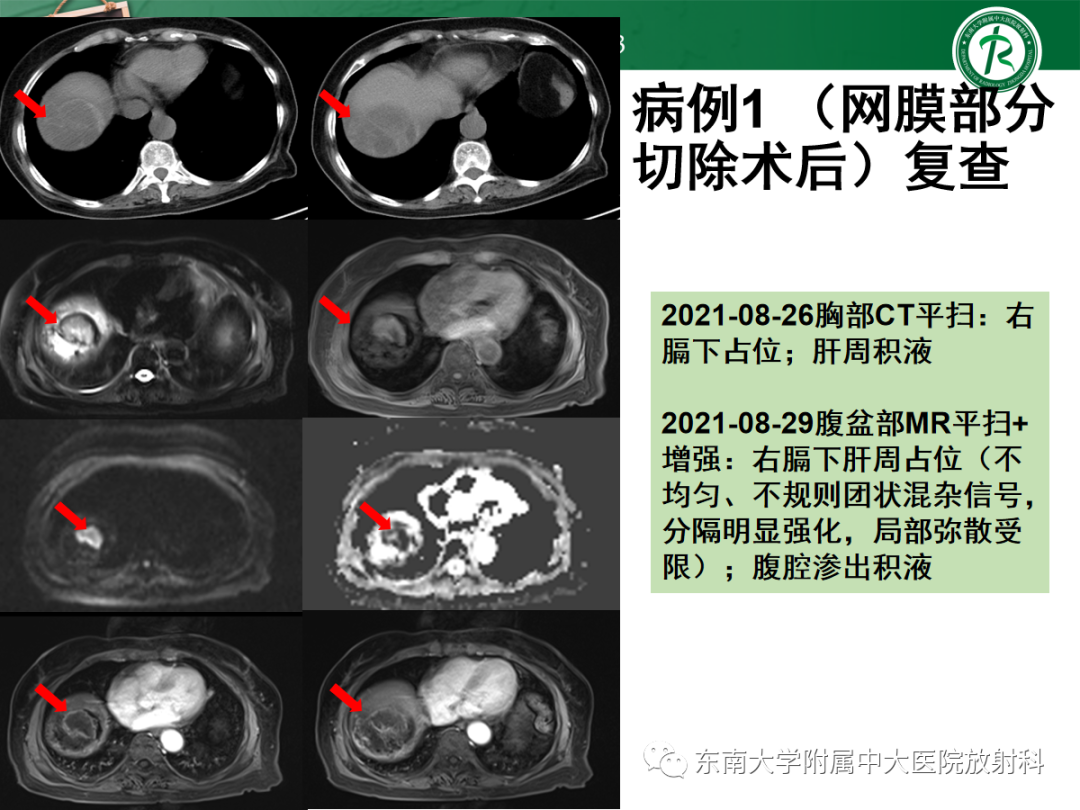 影像PPT - 【PPT】腹膜弥漫性病变-9