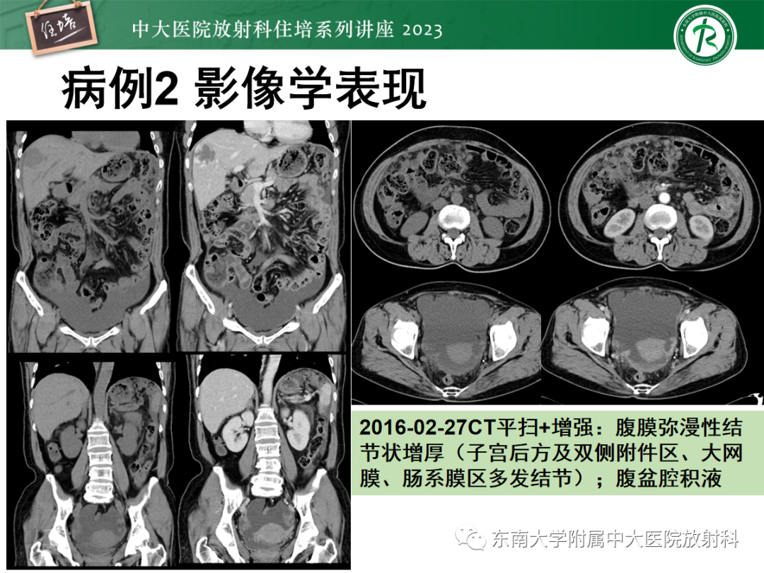 影像PPT - 【PPT】腹膜弥漫性病变-12