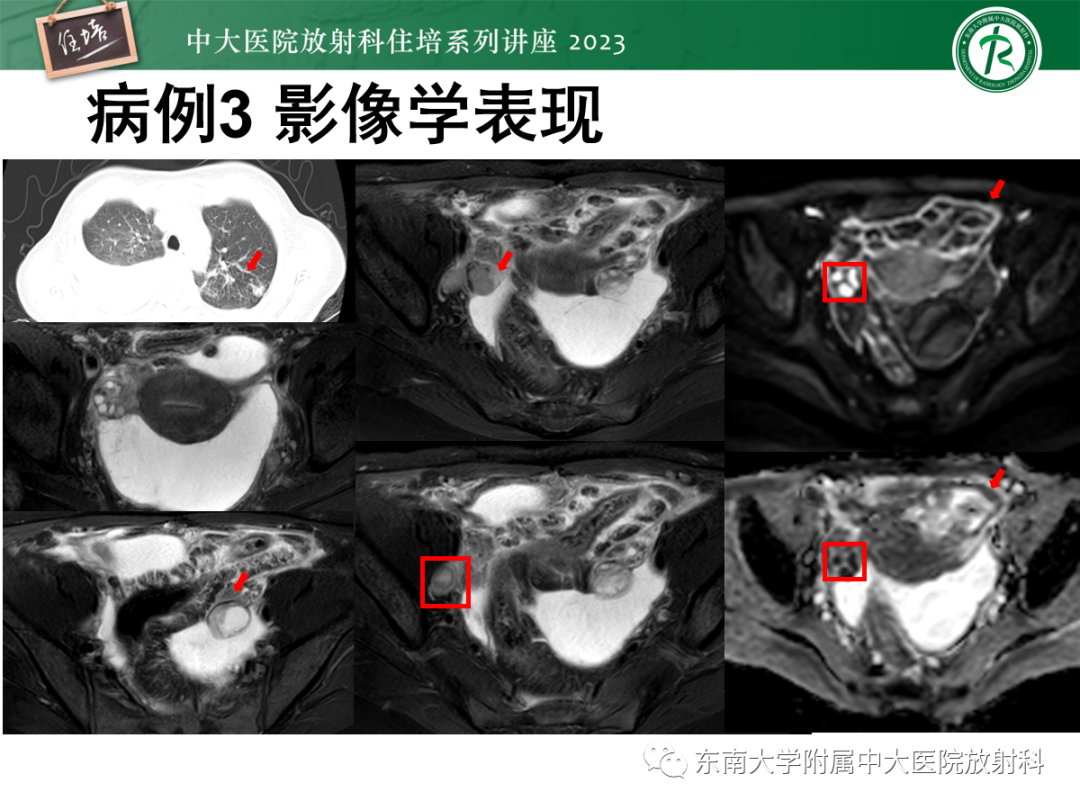 影像PPT - 【PPT】腹膜弥漫性病变-17