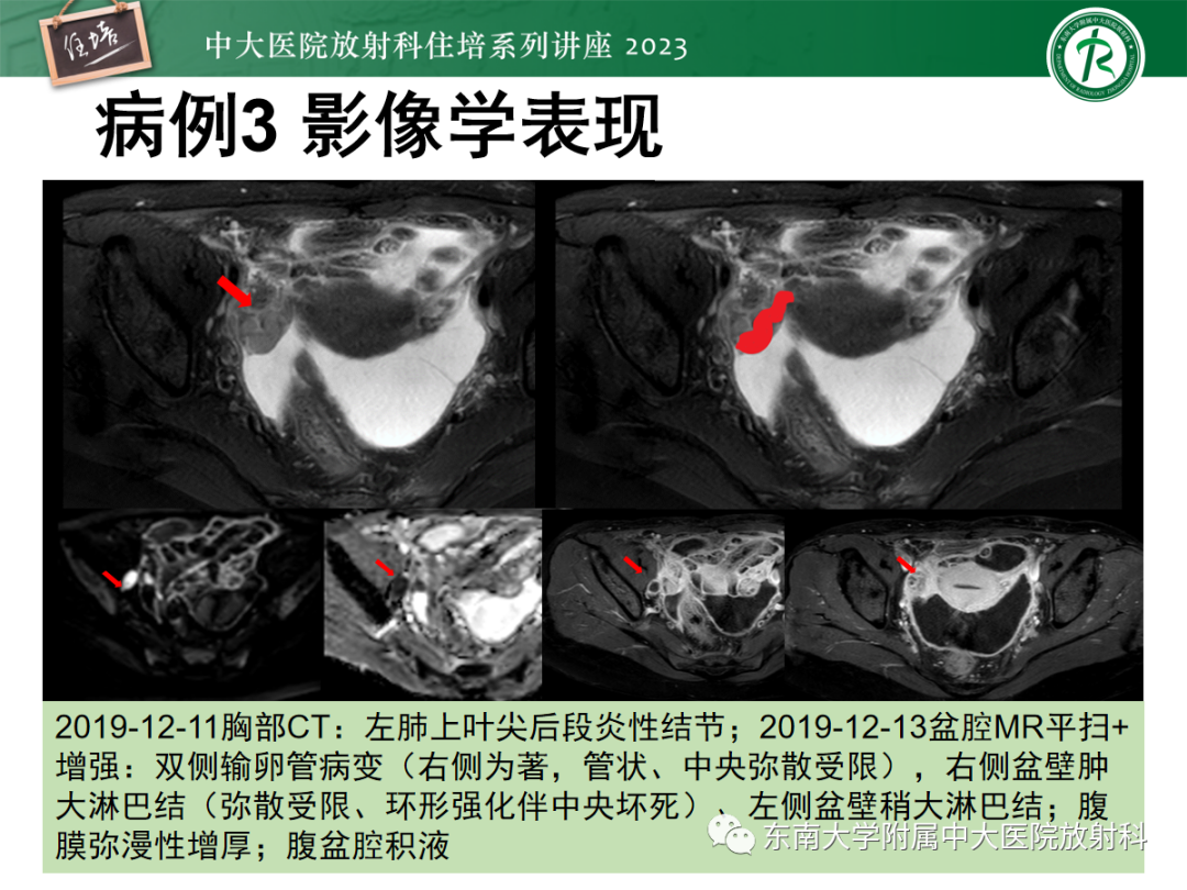 影像PPT - 【PPT】腹膜弥漫性病变-18
