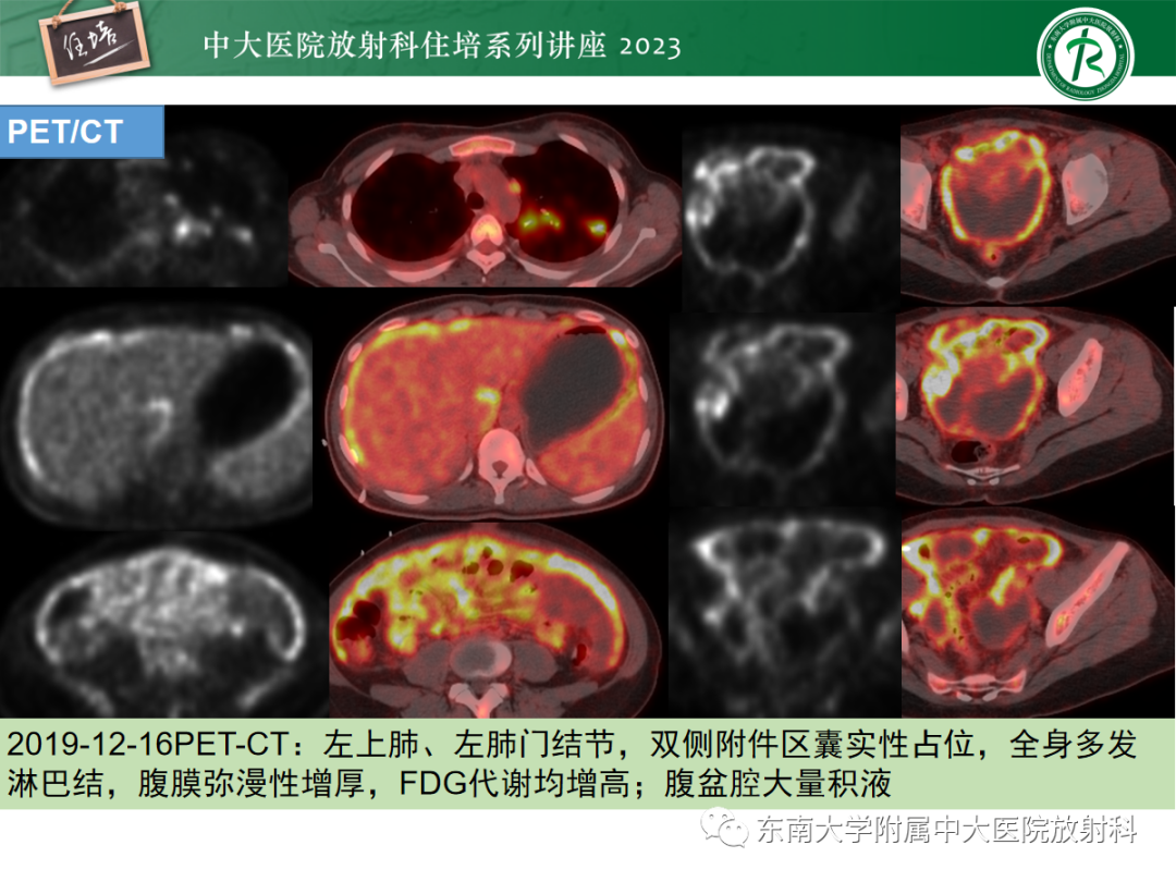 影像PPT - 【PPT】腹膜弥漫性病变-19