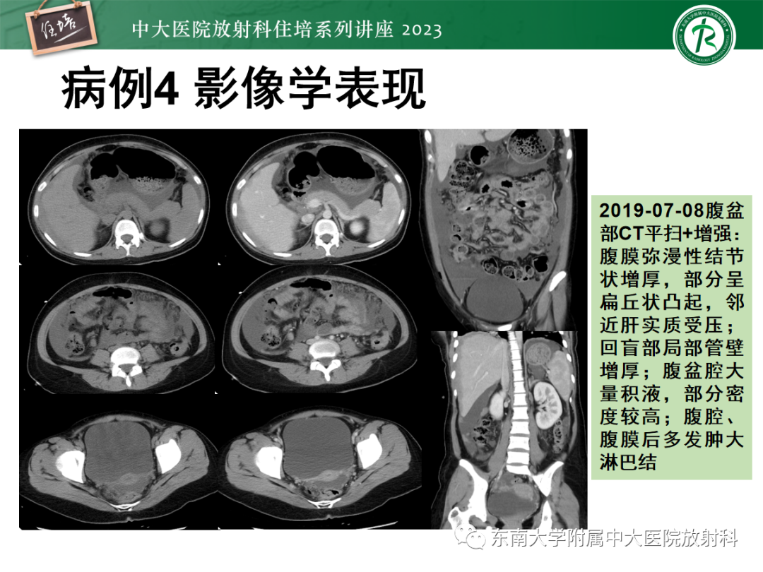 影像PPT - 【PPT】腹膜弥漫性病变-22