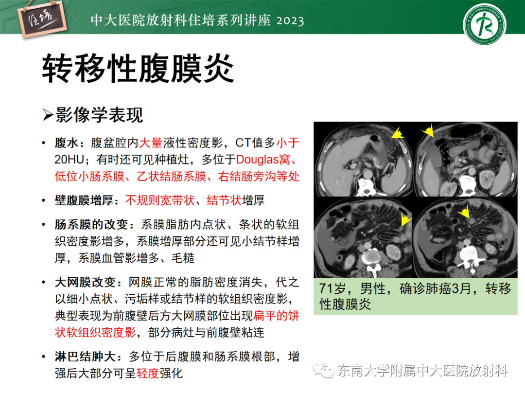 影像PPT - 【PPT】腹膜弥漫性病变-31