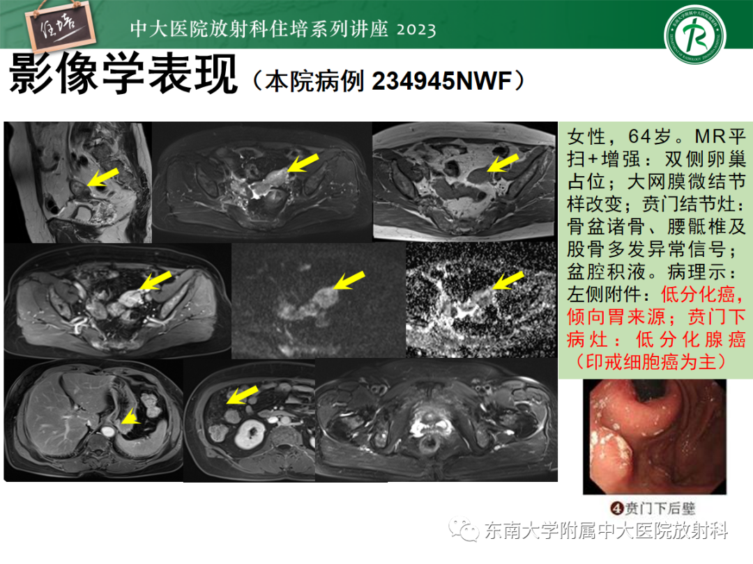 影像PPT - 【PPT】腹膜弥漫性病变-32