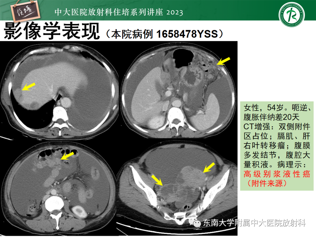 影像PPT - 【PPT】腹膜弥漫性病变-33