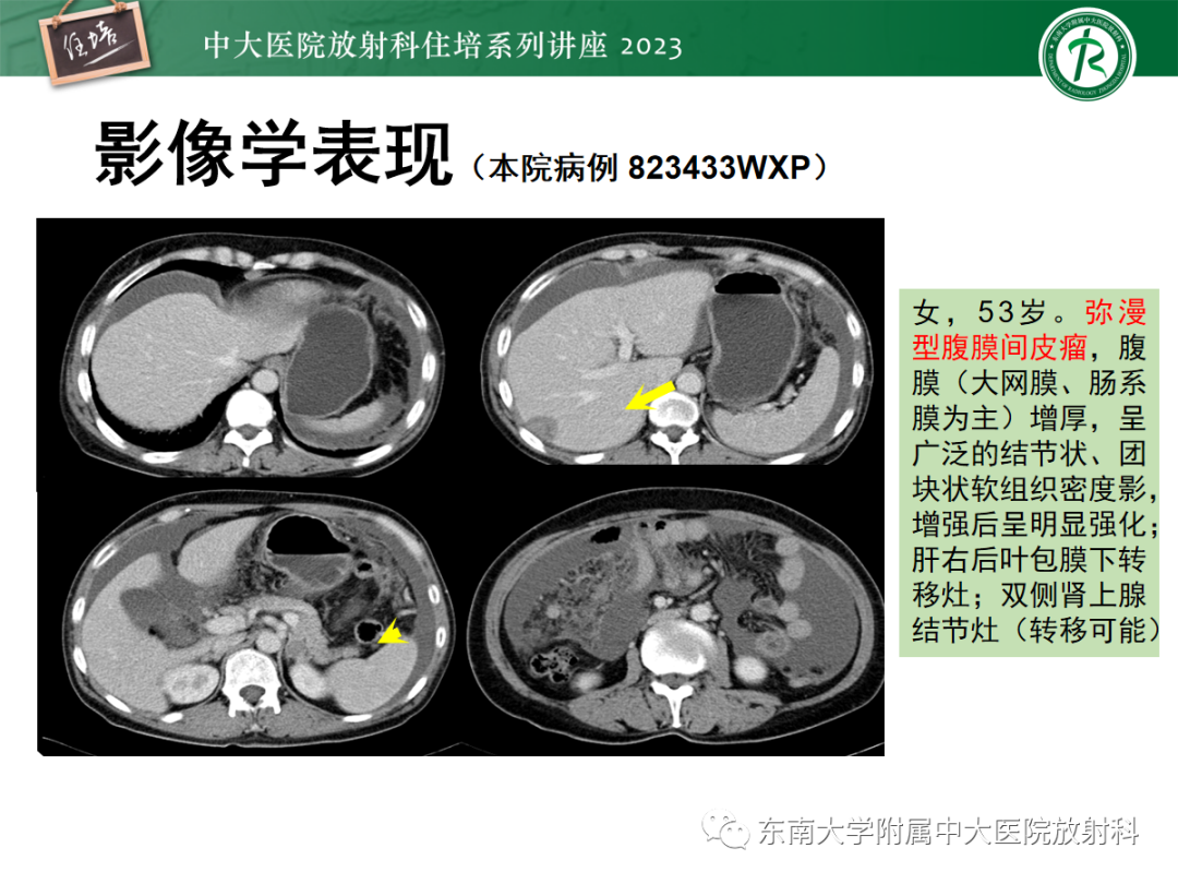 影像PPT - 【PPT】腹膜弥漫性病变-36