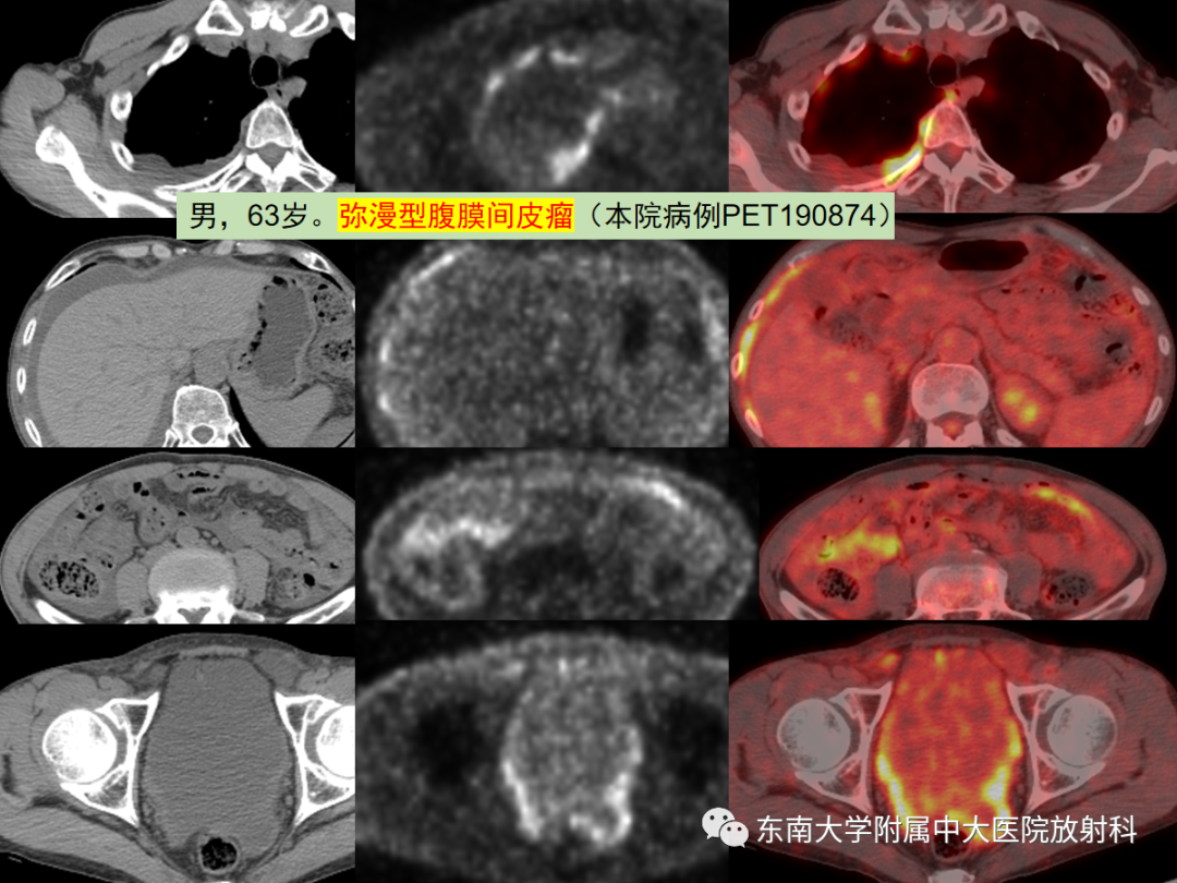 影像PPT - 【PPT】腹膜弥漫性病变-37