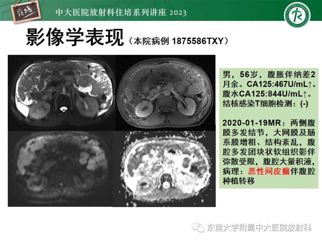 影像PPT - 【PPT】腹膜弥漫性病变-38