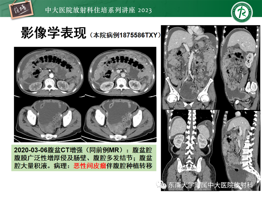 影像PPT - 【PPT】腹膜弥漫性病变-39